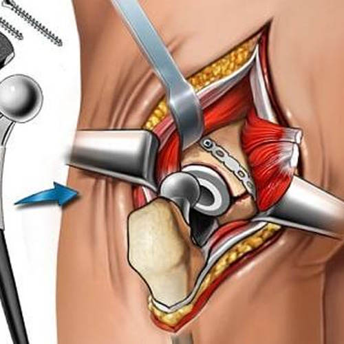 hip replacement surgeon in Vijayawada