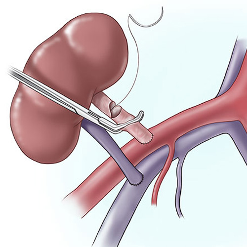 Best kidney transplant hospital in Vijayawada