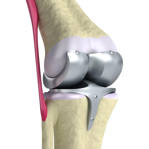 knee replacement in vijayawada