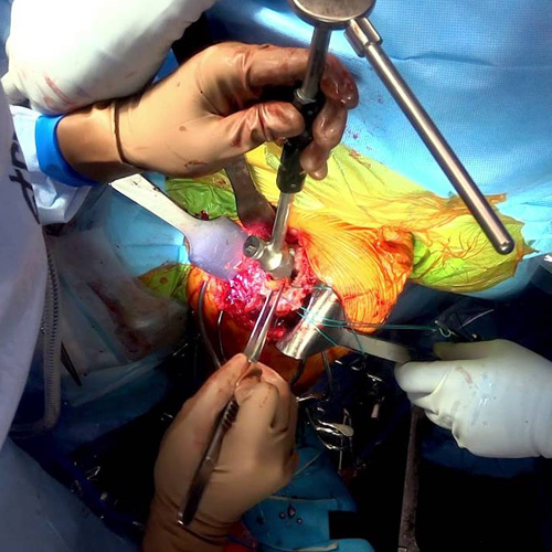 shoulder replacement surgery in Vijayawada